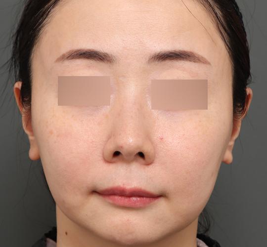 40代女性のジュべルック After 症例写真