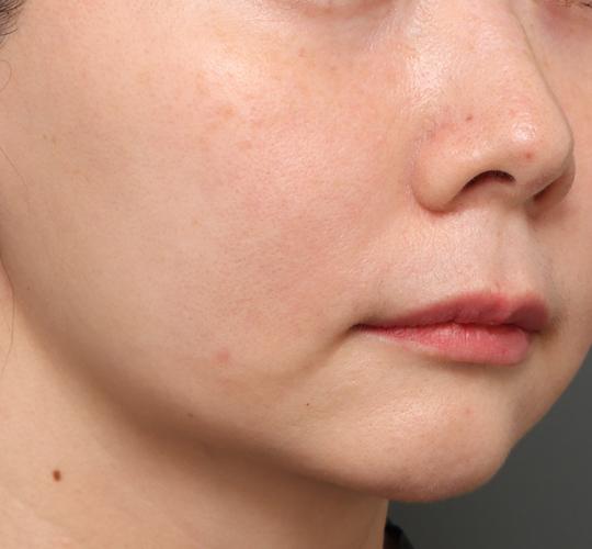 40代女性のジュべルック After 症例写真