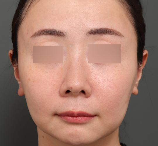 40代女性のジュべルック Before 症例写真