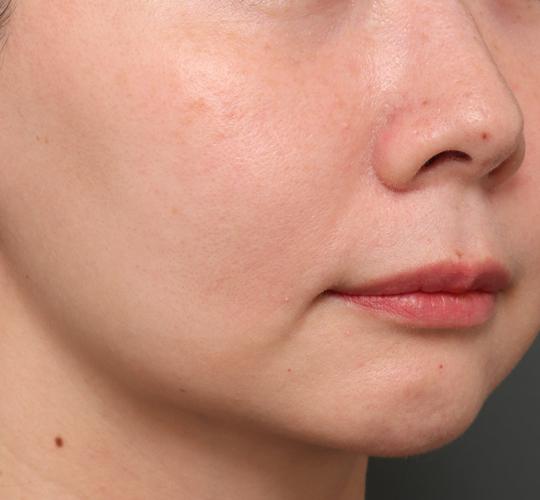 40代女性のジュべルック Before 症例写真
