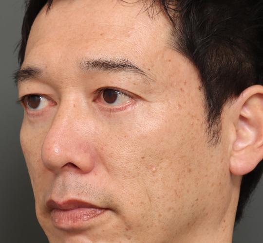 40代男性のハムラ法（目の下のたるみ取り） After 症例写真