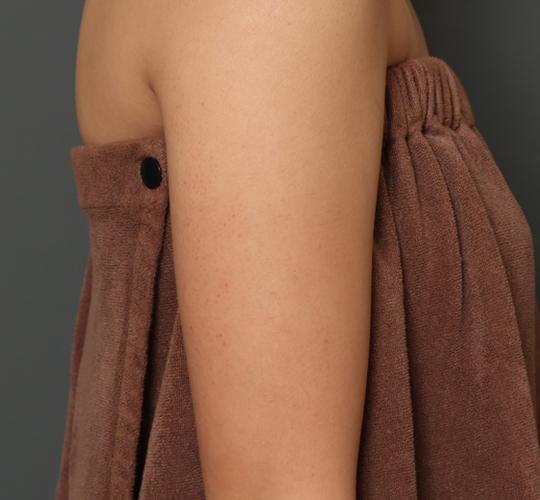 20代女性の毛孔性苔癬ダーマペン4 After 症例写真