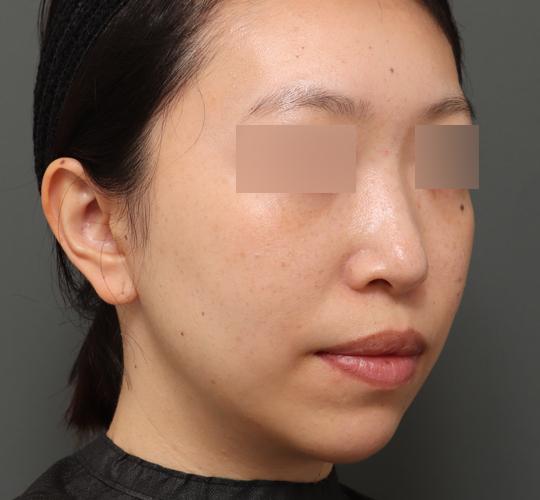 30代女性の顔の脂肪吸引 After 症例写真