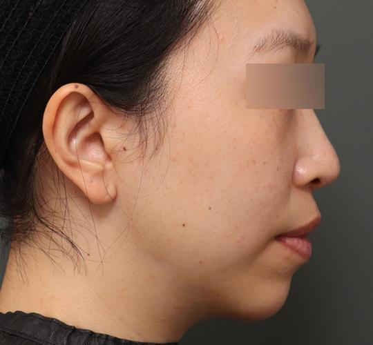 30代女性の顔の脂肪吸引 After 症例写真