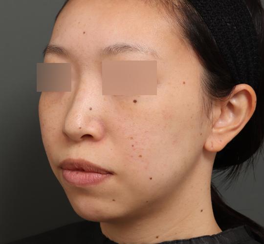 30代女性の顔の脂肪吸引 Before 症例写真