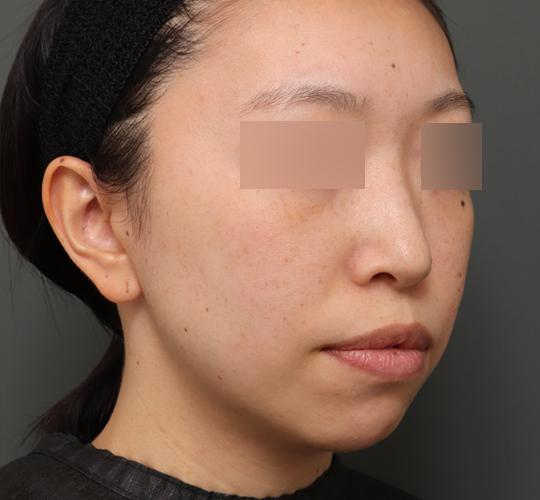 30代女性の顔の脂肪吸引 Before 症例写真