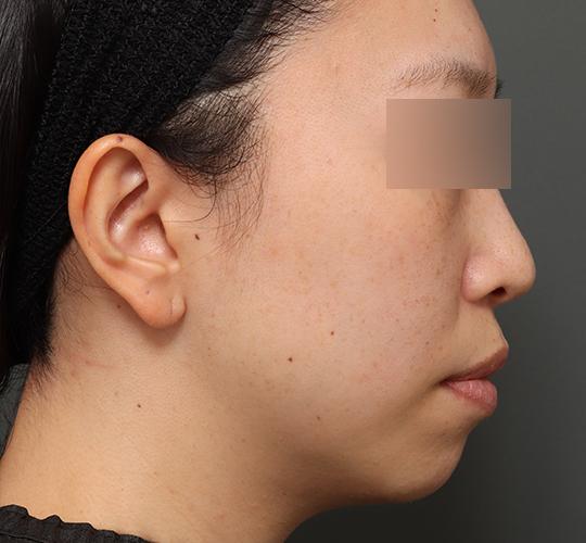 30代女性の顔の脂肪吸引 Before 症例写真