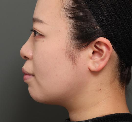 20代女性の顔の脂肪吸引  After 症例写真