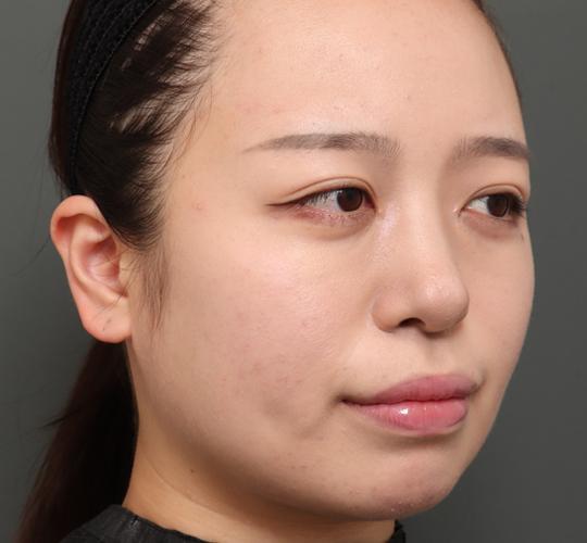 20代女性の顔の脂肪吸引  After 症例写真