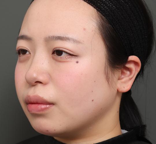 20代女性の顔の脂肪吸引  Before 症例写真