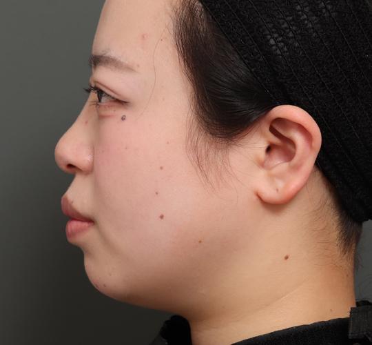 20代女性の顔の脂肪吸引  Before 症例写真