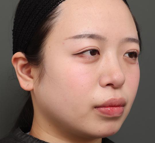 20代女性の顔の脂肪吸引  Before 症例写真