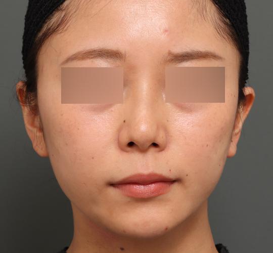 30代女性の顔の脂肪吸引  After 症例写真