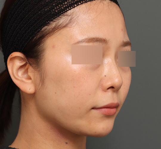 30代女性の顔の脂肪吸引  After 症例写真