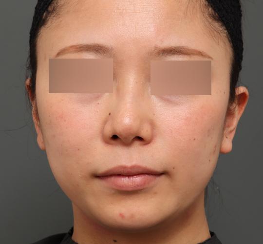 30代女性の顔の脂肪吸引  Before 症例写真