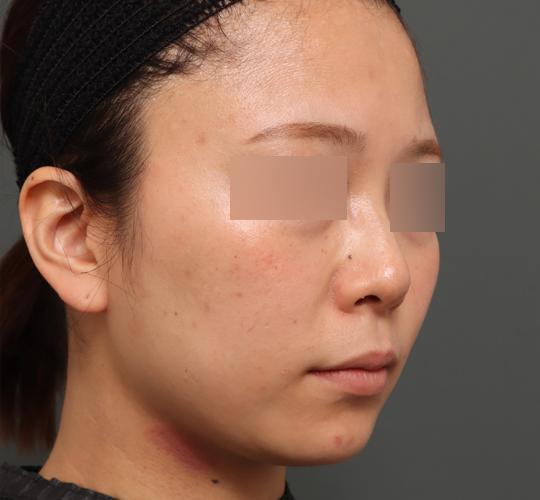 30代女性の顔の脂肪吸引  Before 症例写真