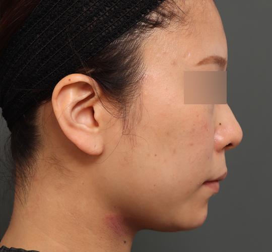 30代女性の顔の脂肪吸引  Before 症例写真