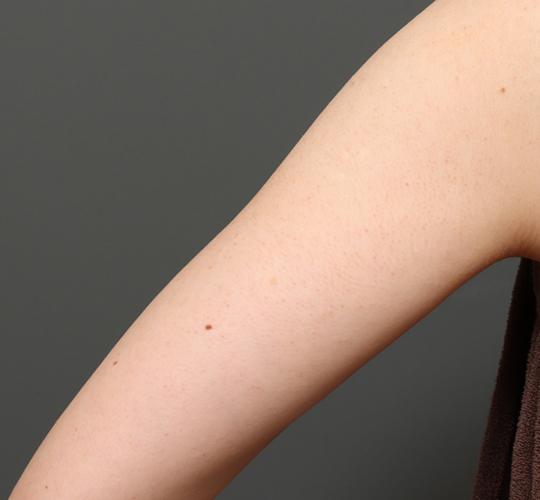 30代女性の毛孔性苔癬・角化症 After 症例写真