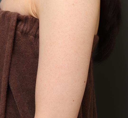 30代女性の毛孔性苔癬ダーマペン4 After 症例写真