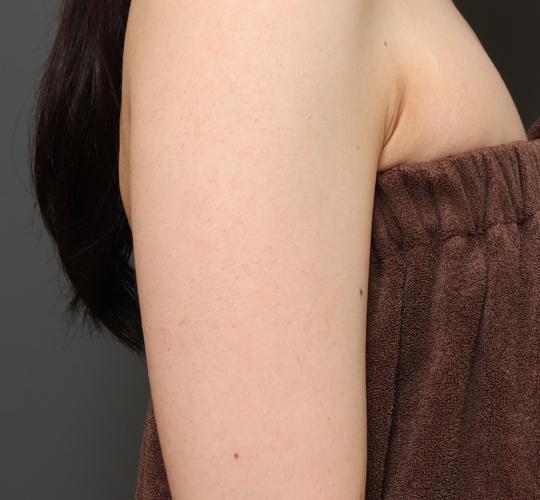 30代女性の毛孔性苔癬ダーマペン4 After 症例写真