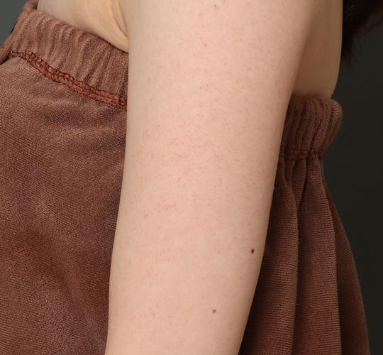 30代女性の毛孔性苔癬ダーマペン4 Before 症例写真