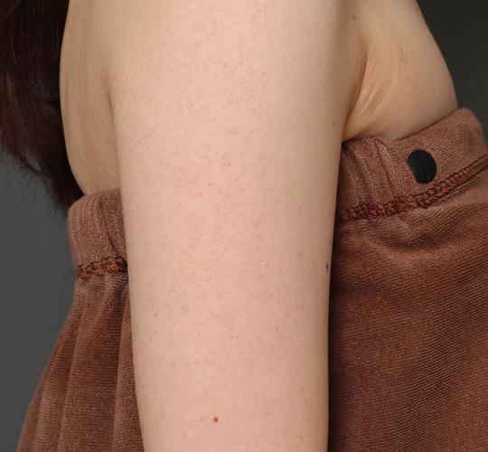 30代女性の毛孔性苔癬ダーマペン4 Before 症例写真