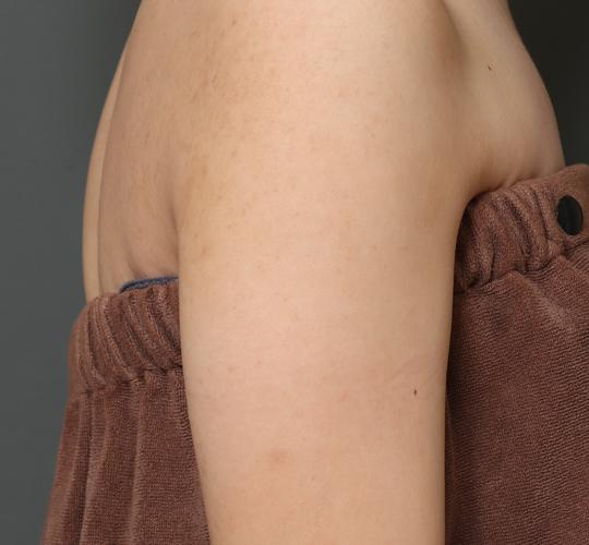 20代女性の毛孔性苔癬ダーマペン4 After 症例写真