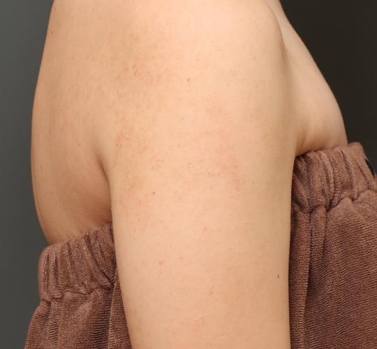 20代女性の毛孔性苔癬ダーマペン4 Before 症例写真