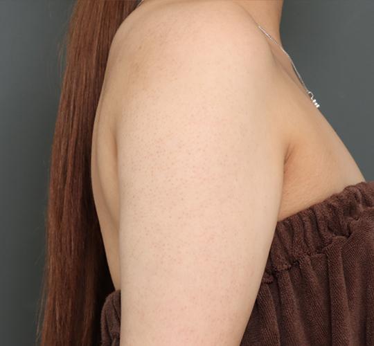 20代女性の毛孔性苔癬ダーマペン4 After 症例写真