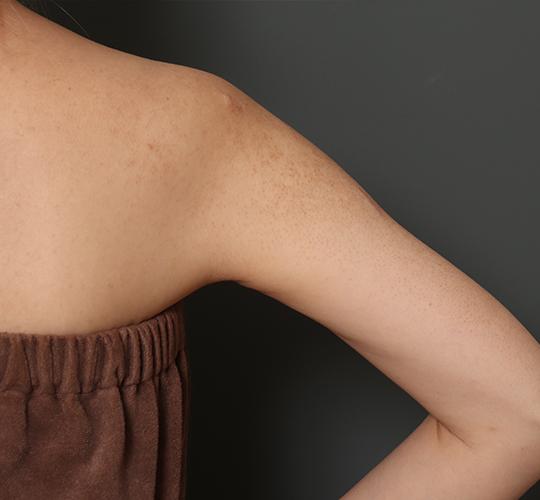 40代女性の毛孔性苔癬ダーマペン4 Before 症例写真