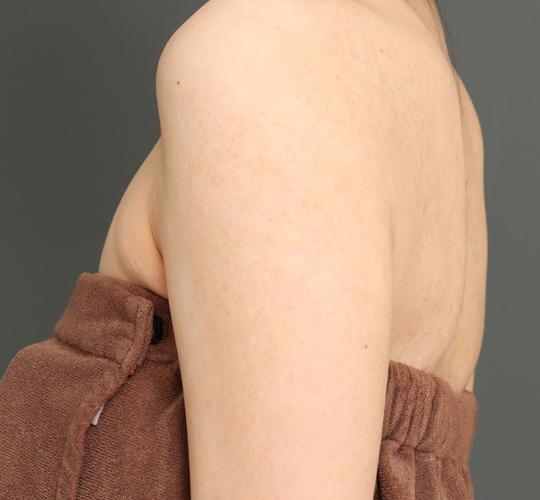 20代女性の毛孔性苔癬ダーマペン4 After 症例写真