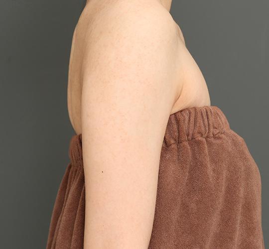 20代女性の毛孔性苔癬ダーマペン4 After 症例写真