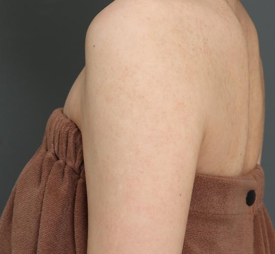 20代女性の毛孔性苔癬ダーマペン4 Before 症例写真