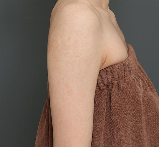 20代女性の毛孔性苔癬ダーマペン4 Before 症例写真