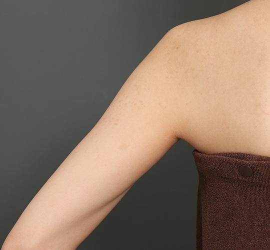 20代女性の毛孔性苔癬ダーマペン4 After 症例写真