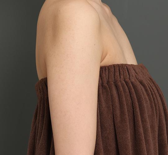 20代女性の毛孔性苔癬ダーマペン4 After 症例写真