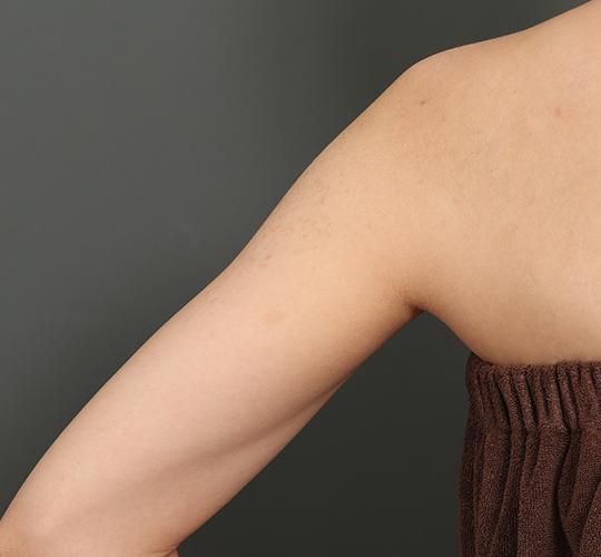 20代女性の毛孔性苔癬ダーマペン4 Before 症例写真