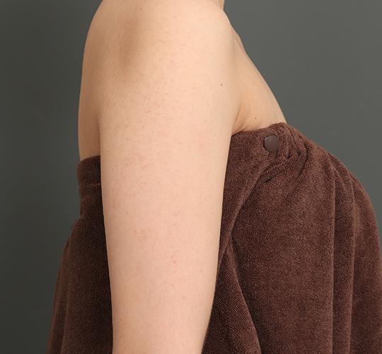 20代女性の毛孔性苔癬ダーマペン4 Before 症例写真