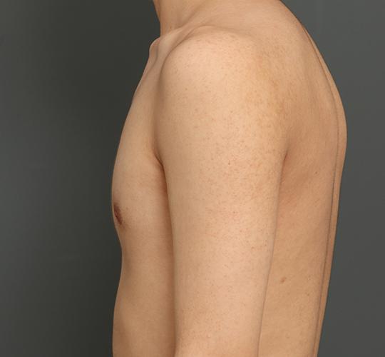 10代男性の毛孔性苔癬ダーマペン4 After 症例写真