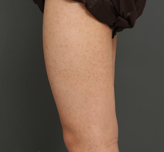 10代男性の毛孔性苔癬ダーマペン4 After 症例写真