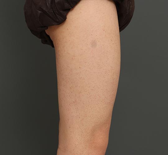 10代男性の毛孔性苔癬ダーマペン4 After 症例写真