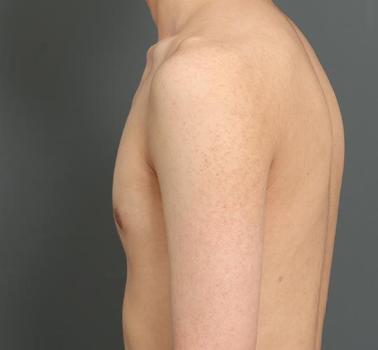 10代男性の毛孔性苔癬ダーマペン4 Before 症例写真