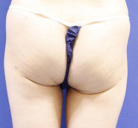 40代女性の脂肪吸引 Before 症例写真