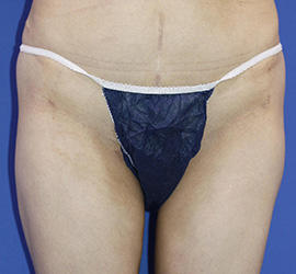 40代女性の脂肪吸引 Before 症例写真