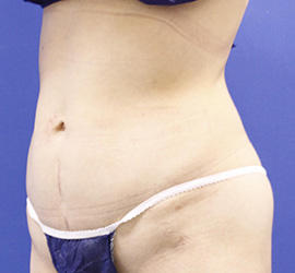 40代女性の脂肪吸引 Before 症例写真