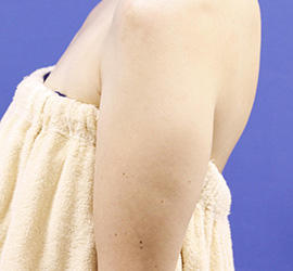 40代女性の脂肪吸引 Before 症例写真