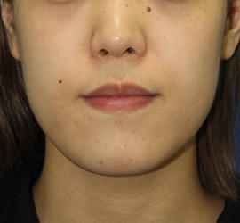 20代女性の顔の脂肪吸引  Before 症例写真