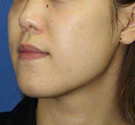 20代女性の顔の脂肪吸引  Before 症例写真