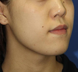 20代女性の顔の脂肪吸引 Before 症例写真