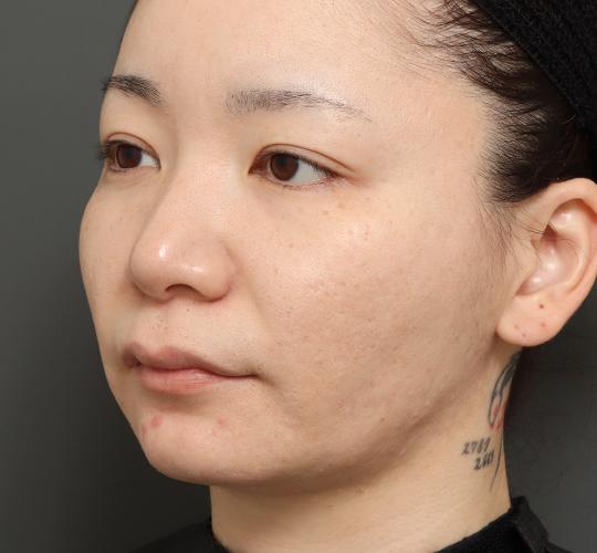 30代女性の顔の脂肪吸引  After 症例写真